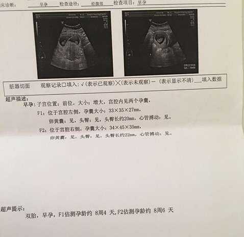 香港验血多久能测出男孩,试管移植8天血值才48，一超双胎见胎芽胎心，保胎越