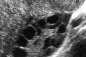 香港验血查男女是查哪个数据,月经期、孕早期能不能做阴道超声？